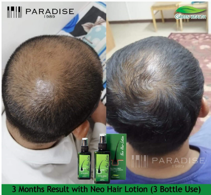 Mua Neo Hair Lotion + 540 Roller Gift Herbs 100% Natural Treatment Spray  Stop Hair Loss Root Nutrients 4.2 Oz./120 trên Amazon Anh chính hãng 2023 |  Giaonhan247
